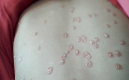 什么是点滴型银屑病
