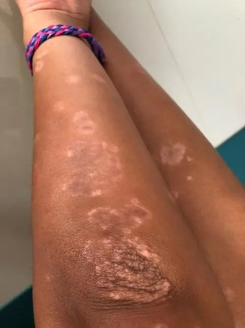 如何预防银屑病加重